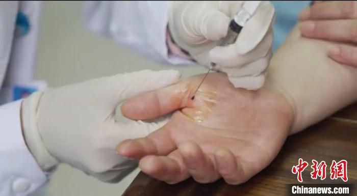 嘉善群眾體驗小針刀?！〖紊平y戰(zhàn) 供圖