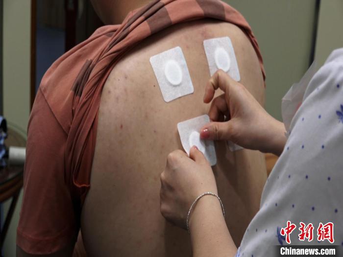 圖為醫(yī)生正在為民眾貼“三伏貼”?！√莆登?攝